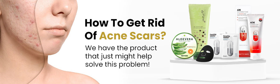 What causes acne and how to cure acne scars?